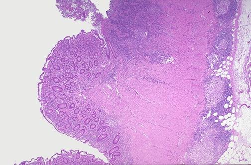Chronic inflammatory involvement of mucosal, submucosal, and muscularis layers of bowel wall (transmural inflammation), manifested mainly by lymphocytic infiltration with associated lymphoid