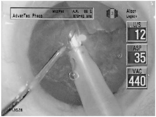 The posterior nuclear plate was torn from the periphery toward the center by cross action with the phacoemulsification tip and a custom, modified, 0.37 mm cyclodialysis spatula (Figure 3).