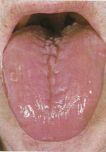 Acute glossitis due to