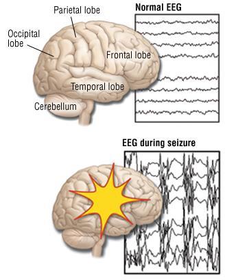 4.1.3. EEG, CT, MR Nije potrebno obaviti EEG kod rutinske pretrage neurološki zdravog djeteta koje se bori s prvim konvulzijama u febrilitetu kroz prva 48h (10,12).