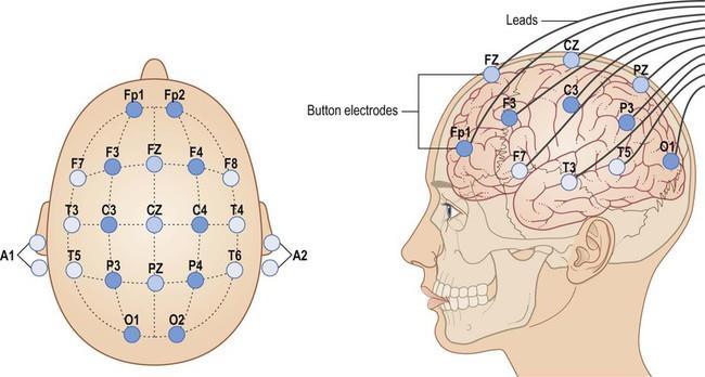 Slika 11. Postava elektoroda kod EEG a (24) 4.2. Dijagnoza febrilnih konvulzija Kod febrilnih konvulzija dijagnoza se postavlja na temelju anamneze, neurološkog i pedijatrijskog pregleda (10,12).