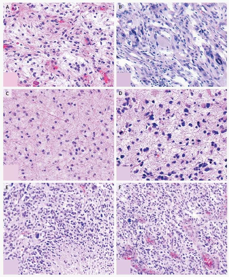 WHO Grading System for Astrocytomas Type I: pilocytic astrocytoma (panel A) Type II: diffuse