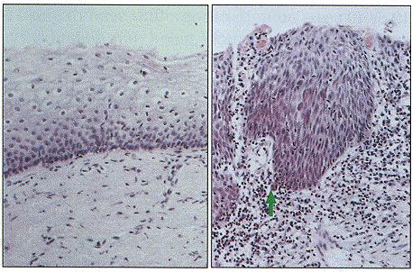 Invasion Initial tumor is produced from a clone of neoplastic cells that overgrow (hyperplasia) and ignore