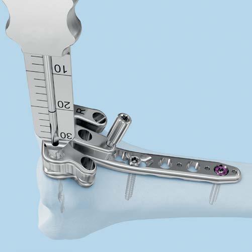Screw Insertion Variable Angle Locking Screws Option C: Nominal angle technique Using guiding blocks Optional instruments 03.110.021 1.