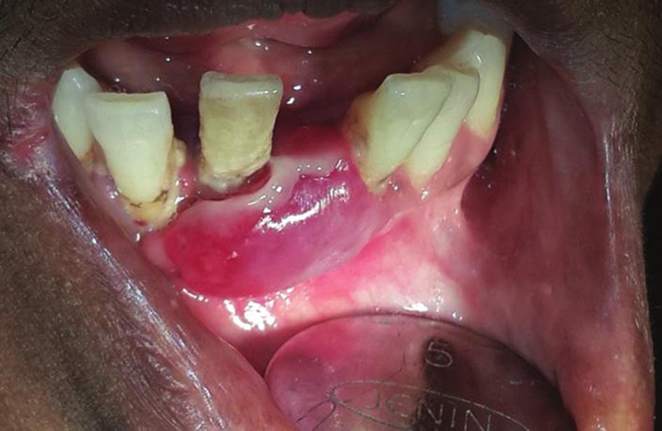 Reactive lesions of oral cavity Hunasgi, et al.