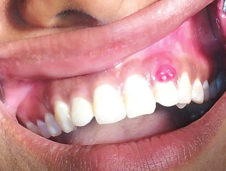 the reactive lesions of the gingiva and reported in only 5% of the biopsy reports according to the published literature.