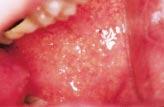 ORAL MEDICINE Orofacial Disease: Update For The Dental Clinical Team: 3. White Lesions Crispian Scully and Stephen Porter Abstract: White lesions usually contain an increased amount of keratin.