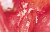 Figure 2. Oral thrush. that the condition is benign, is available or needed. Dyskeratosis Congenita This is another rare autosomal dominant condition, similar to white sponge naevus.