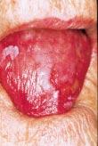 INFECTIVE LESIONS Candidosis (candidiasis) Candida albicans is a harmless commensal in the mouths of nearly 50% of the population but, under suitable circumstances such as when there is a disturbance
