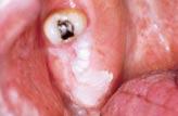 Figure 10. Leukoplakia before toluidine blue staining. frequently in severely dysplastic lesions.