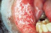 In a study of 45 patients with oral dysplastic lesions followed for up to 8 years, about 11% underwent malignant change in this period but up to 30% of them regressed or even disappeared