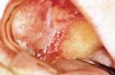 Snuff-dipping is associated predominantly with verrucous keratoses, which can occasionally progress to verrucous carcinoma, but only after several decades of snuff use.
