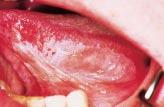 Snuff dippers lesions will resolve on stopping the habit even after 25 years of use. Sublingual Keratosis The aetiology for this condition is unknown. Figure 15. Sublingual keratosis.