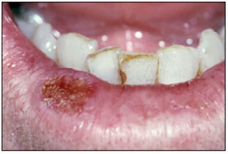 Figure 1. An SCC of the lower lip presenting as an ulcer. Notice the lack of a defined vermillion border and edema consistent with the SCC arising in the setting of actinic cheilitis.