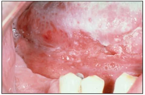 Non-healing ulcer Sites of Involvement Squamous cell carcinoma can arise from the mucosa anywhere in the head and neck.