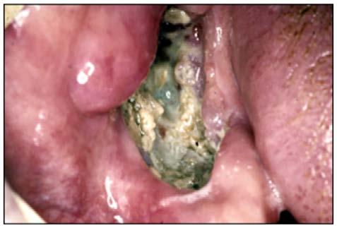 body, cancer of the mouth is staged using the TMN system where T stands for tumor size, N for the presence or absence of tumor involvement in regional lymph nodes and M for the presence or absence of