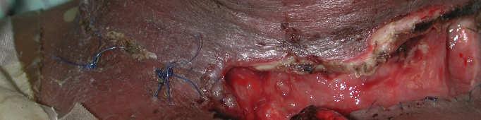 Radiation necrosis Chronic laryngeal edema