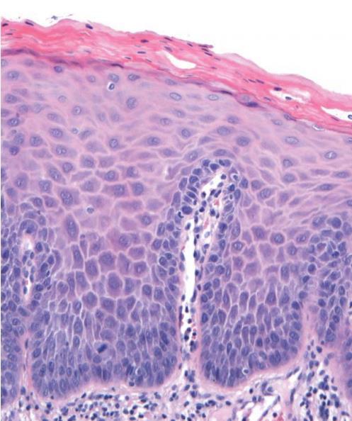 HISTOPATHOLOGICAL TERMINOLOGY Friedman & Ferlito have used the term LARYNGEAL INTRAEPITHELIAL NEOPLASIA (LIN) LIN I (mild/minimal dysplasia) Stratification is preserved and cellular layers in the