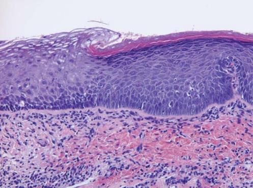 HISTOPATHOLOGICAL TERMINOLOGY Friedman & Ferlito have used the term LARYNGEAL INTRAEPITHELIAL NEOPLASIA (LIN) LIN II (moderate dysplasia) Histologic changes similar to LIN I, but abnormalities extend