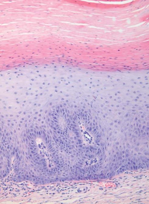HISTOPATHOLOGICAL TERMINOLOGY SQUAMOUS METAPLASIA Replacement of normal respiratory epithelium by stratified squamous epithelium Can follow persistent trauma or
