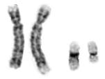Results: CIC DUX4 positive cases Case Cytogenetics RT PCR FISH CIC DUX4 EWS SYT DSRCT CIC DUX4 CIC EWS SYT 16 t(4;19) + + + 17 t(4;19) + + + 21 N/A + + + 23 N/A + + + 16 excluded of which 9 had EWS