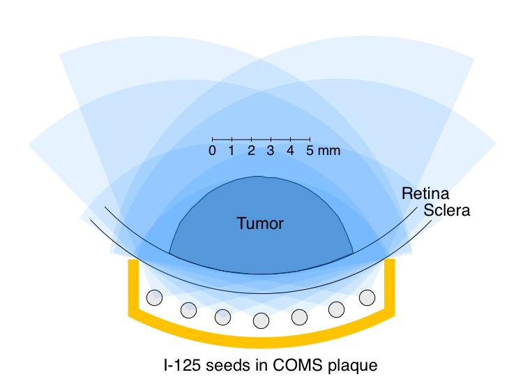 Every seed in a COMS plaque irradiates the retina and sclera under the tumor and adjacent to the plaque.