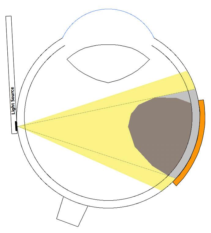 How Plaques Were Surgically Positioned Historically, plaques have assumed simple shapes (e.g. circular perimeters) because the precise shape of the tumor base and its location within the eye were not available for advance treatment planning.