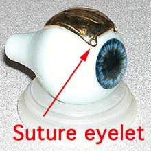 A plaque that fits the tumor and ocular anatomy is selected.