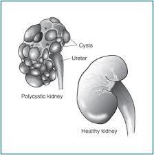Polycystic Kidney Disease Disease 2009 2010 2011 2012 New Zealand