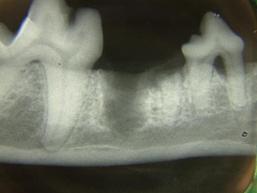 Root remnant (fractured): radiograph & remove. Do NOT atomise!!! Warning!
