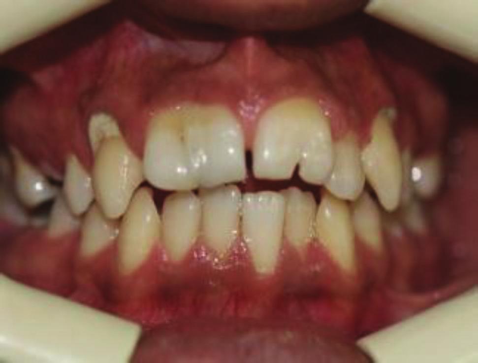 2 Case Reports in Dentistry Figure 1: Intraoral facial view. Figure 3: Panoramic view. Figure 2: Intraoral palatal view.