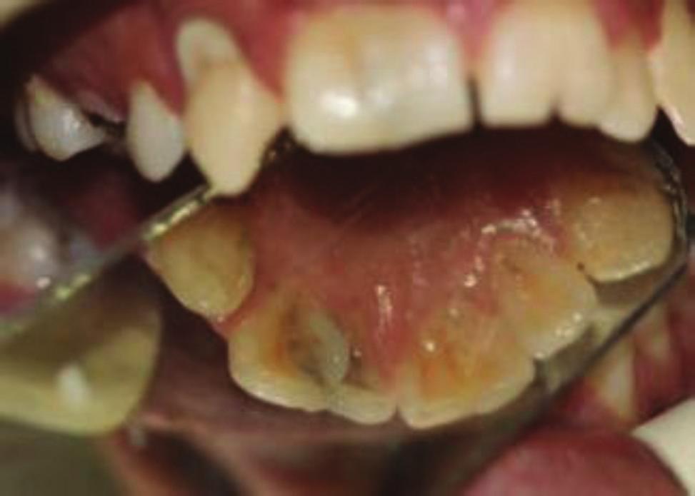 Case Description A 19-year-old male was referred to the Endodontic Department of Babol Dental College with the chief complaint of dental pain and sensitivity to cold in the anterior maxillary region.