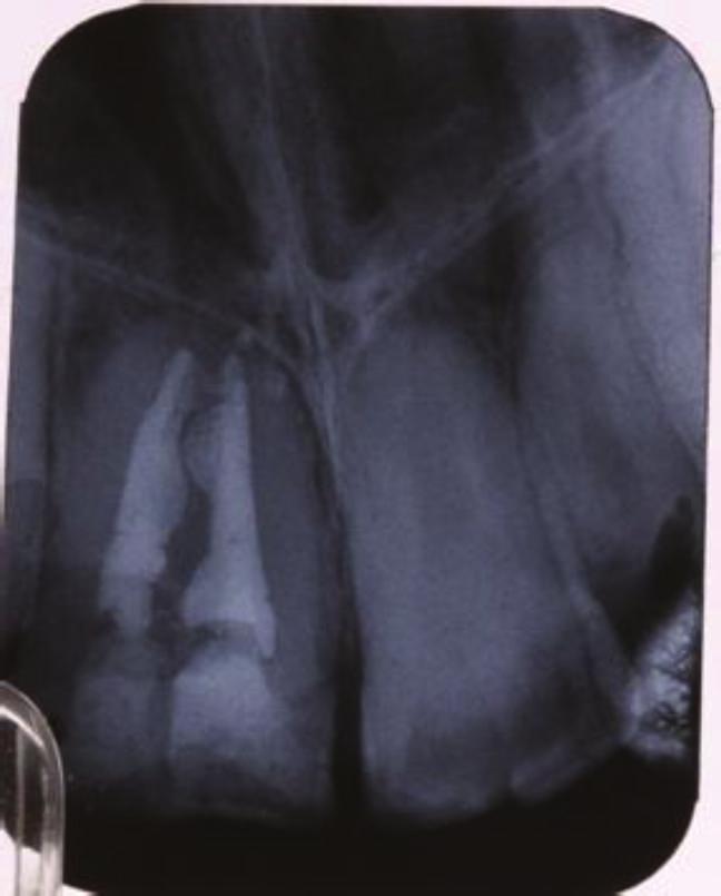 Case Reports in Dentistry 3 Figure 4: Periapical view of the treated canal. Figure 5: Restored palatal view.