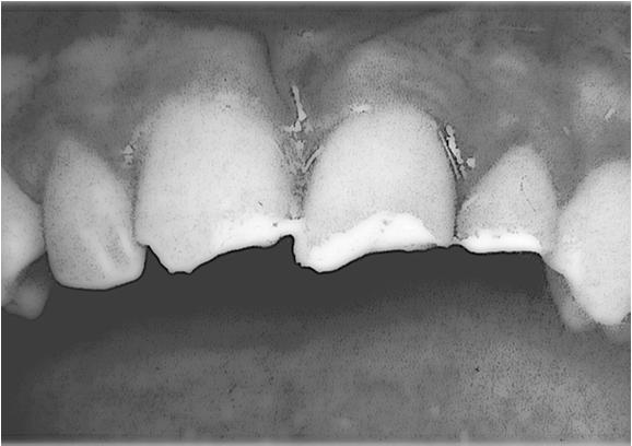 Easy for dentist Dentin Fractures D/C Instructions Follow up in less than a week with
