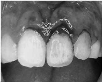 Subluxation (nondisplaced) The Tooth