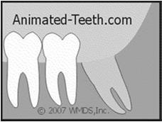 Intruded Teeth In adults, they almost always need to be repositioned and splinted by the dentist. Often assoc. with alveolar bone fracture.