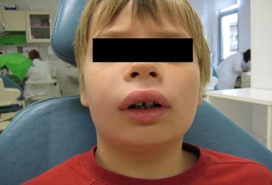 Permanent incisors-abscessus periapicalis Therapy: RCT