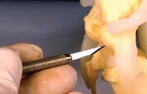 Passing the nylon suture behind the fabella can be a challenging part of the procedure.