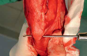 Step Three: Drill hole (2.5 to 3.5mm diameter) in the proximal tibia close to the insertion of the straight patella ligament with a bone tunnel borer or drill.