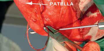 Positioning of distal hole in tibia: In the lateral suture system the proximal position of the loop is always the lateral fabella.