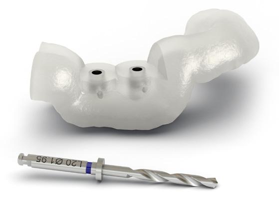 This enables the precise transfer of the 3D planning into the patient s mouth: 1.