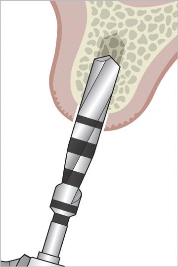 Clip the trephine onto the pilot drill to punch the tissue for flapless surgery and to prepare the bone crest for stable initial drilling. Use the trephine with the Ø4.2 Wide Guide the Ø1.