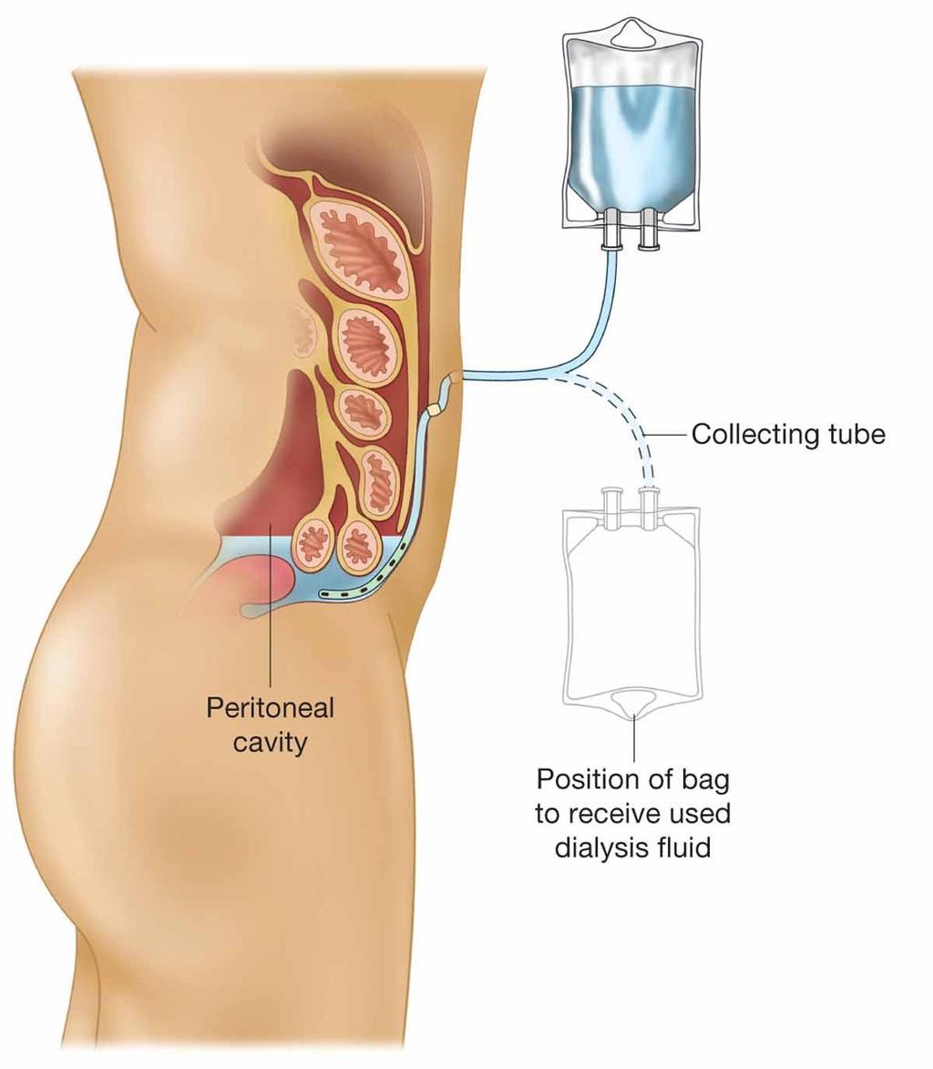 Peritoneal Dialysis (PD) PD clears wastes and fluids through a