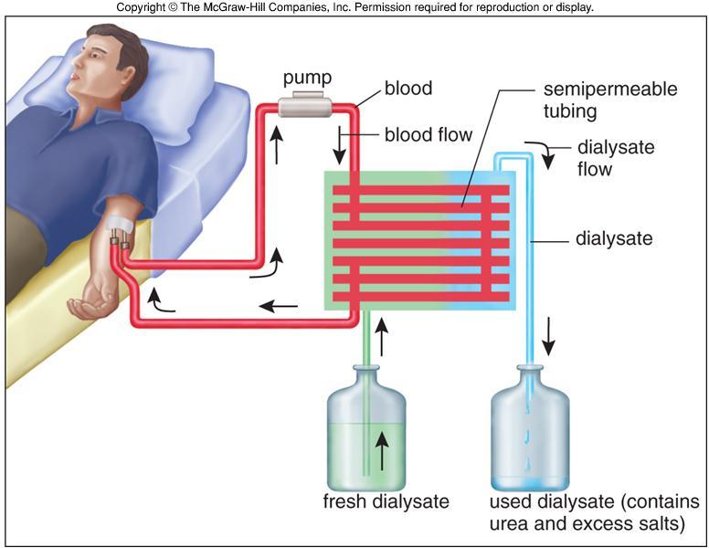 How haemodialysis works Blood is pulled from the person, through chosen access, via a blood pump The blood enters a filter = artificial kidney