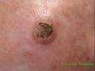 Skin cancer SIR ~14 (