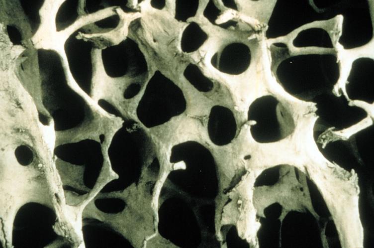 Osteoporosis Normal Osteoporosis is