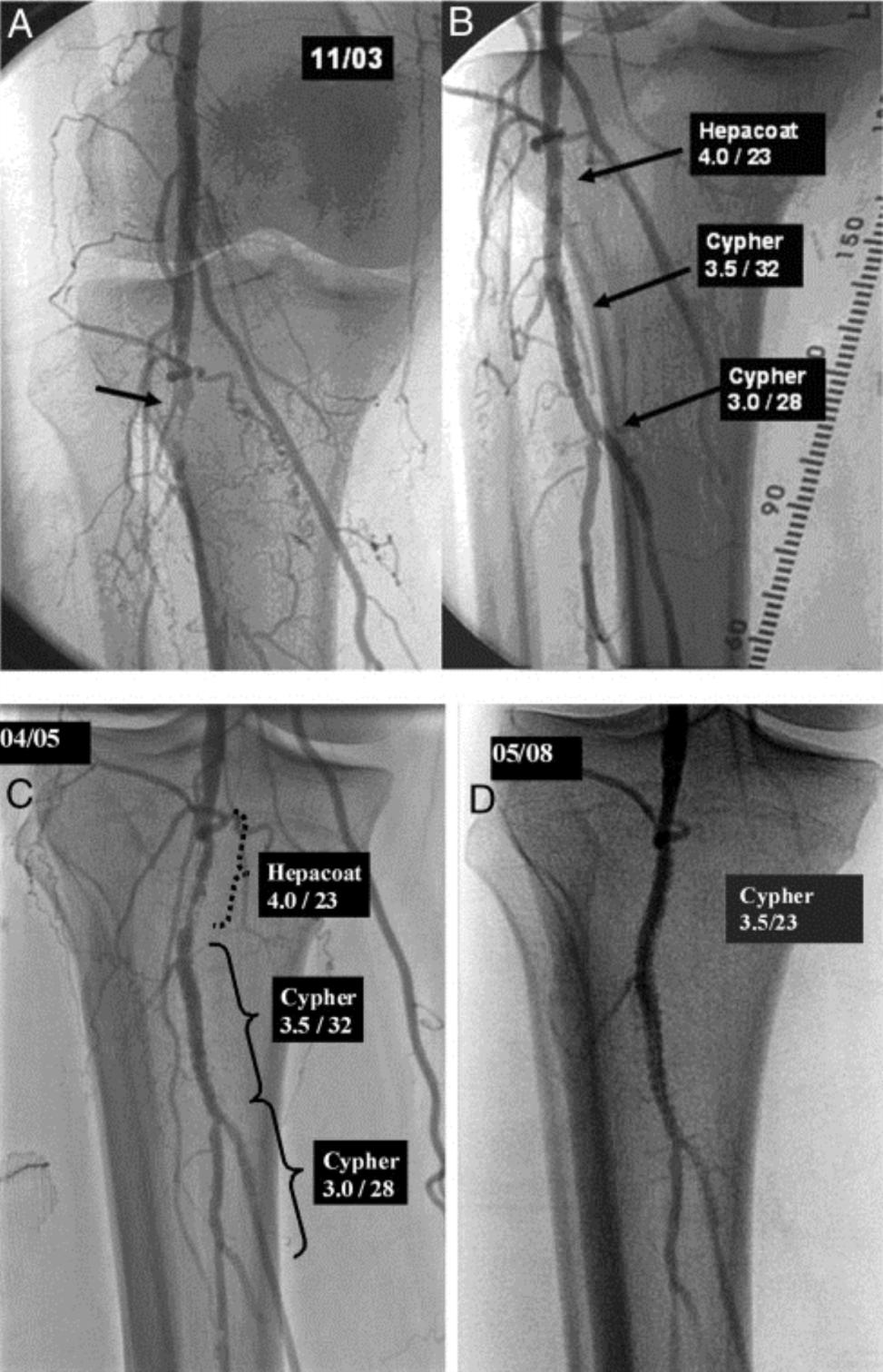 Bare-Metal In-Stent Restenosis Successfully Treated With DES (A) An 87-year-old patient, Rutherford 5 CLI. The arrow indicates popliteal artery occlusion. (B) After placing a proximal 4.