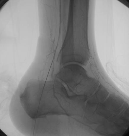 ENTRY IN THE POPLITEAL POSTERIOR