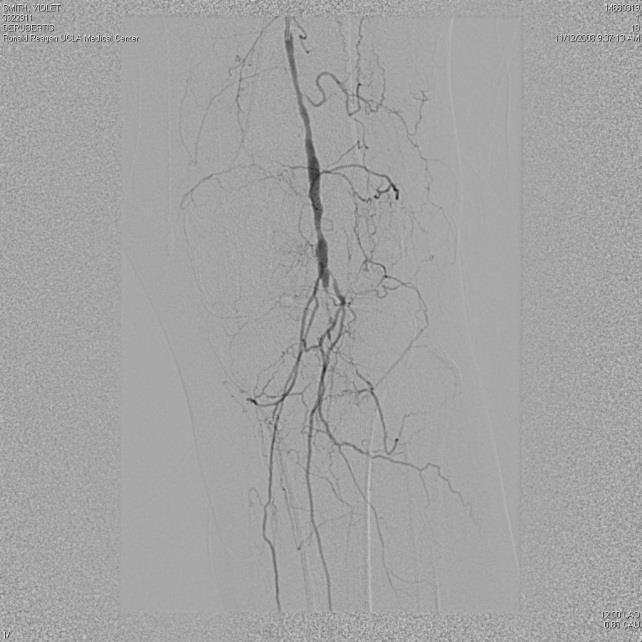 Situations Where Open Surgery Should Be the First Option Anatomy Extensive disease of the common femoral artery Stents ineffective