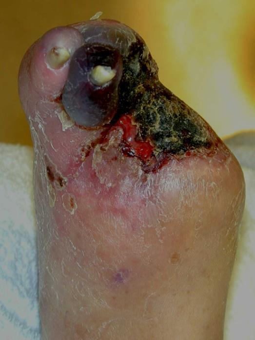 sepsis Extensive forefoot gangrene Need immediate and